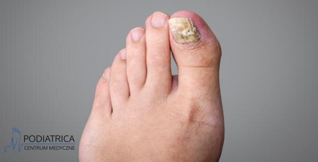 Grzybica stóp: objawy, rodzaje i przyczyny. Jak skutecznie leczyć grzybicę stóp?