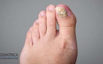 Grzybica stóp: objawy, rodzaje i przyczyny. Jak skutecznie leczyć grzybicę stóp?
