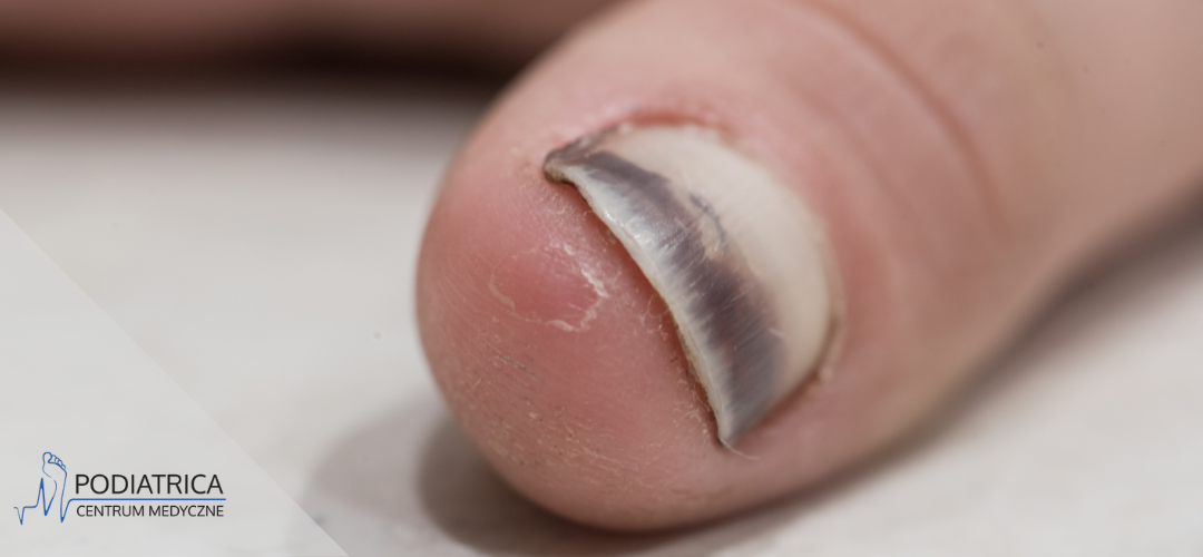 Uszkodzona macierz paznokcia. Jak odbudować paznokieć?
