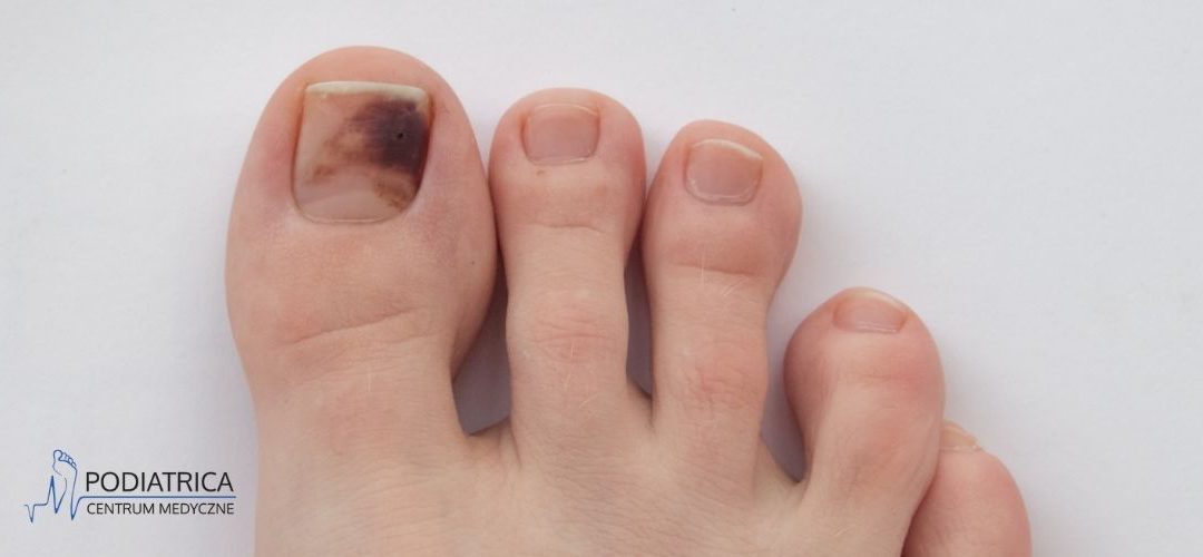 Krwiak pod paznokciem – kiedy wymaga konsultacji z podologiem?