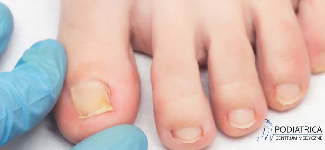 Ortonyksja – dziedzina podologii zajmująca się korektą i leczeniem wrastających paznokci