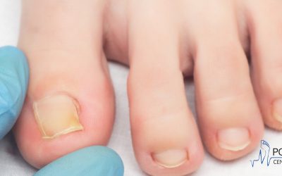 Ortonyksja – dziedzina podologii zajmująca się korektą i leczeniem wrastających paznokci