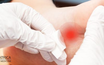 Jak usunąć kurzajki? Kilka sposobów na wirus brodawczaka – HPV